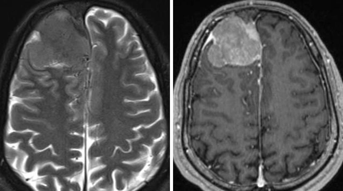 Meningioma